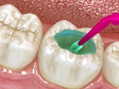 Quy trình trám răng sâu diễn ra như thế nào?