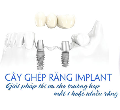Quy trình và cách chăm sóc răng sau khi cắm ghép Implant
