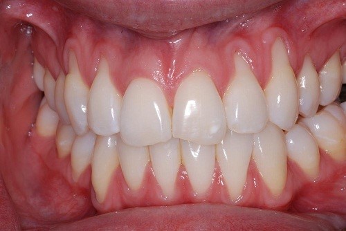 Răng bị tụt lợi cần chữa đúng cách