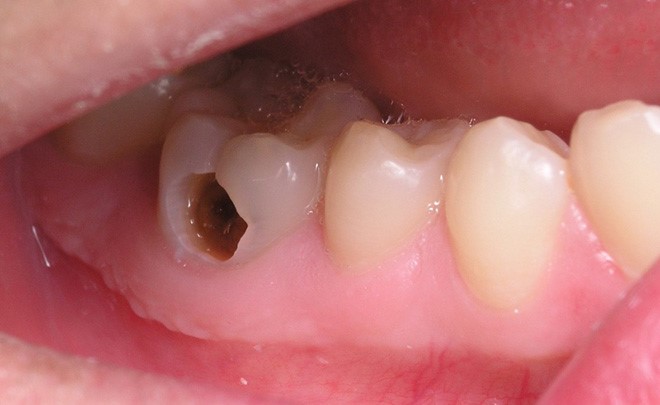 Sâu răng có phải là bệnh lý dễ lây và di truyền?