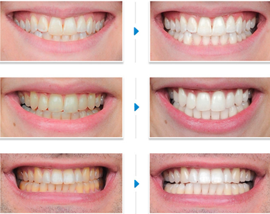 Sự bền đẹp của hàm răng được tẩy trắng từ phương pháp hiện đại