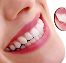 Tại sao bọc sứ răng thưa là sự lựa chọn hoàn hảo?