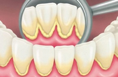 Tại sao phải lấy vôi răng định kỳ tại phòng khám nha khoa?