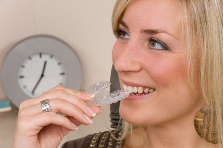 Tại sao phải mang hàm duy trì sau khi tháo niềng răng