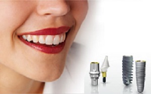 Tiêu xương ảnh hưởng gì trong cấy ghép răng implant
