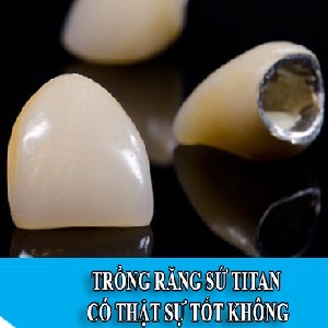 Tìm hiểu về răng sứ Titan