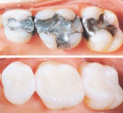 Trám răng có đau không, cách khắc phục trám răng