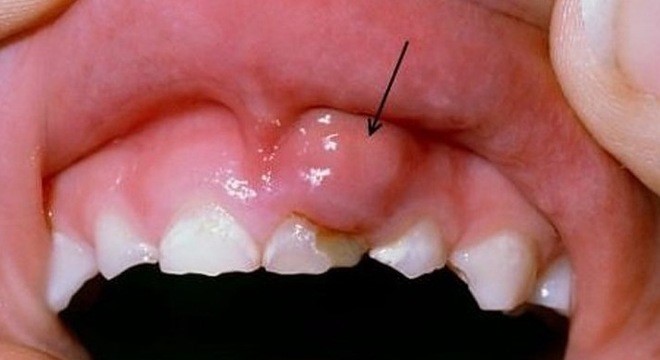 Ung thư miệng, 1 trong 6 bệnh thường gặp ở con người