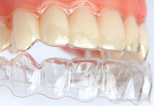 Ưu điểm khiến bạn không nên bỏ qua phương pháp niềng răng không mắc cài