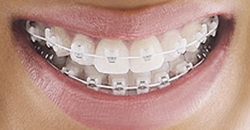 Vì sao nên chọn niềng răng mắc cài sứ