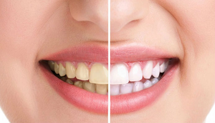 Vôi răng là gì? Tại sao phải cạo vôi răng