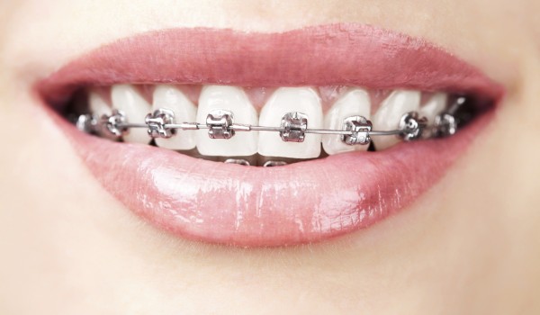 3 yếu tố phải đảm bảo khi niềng răng