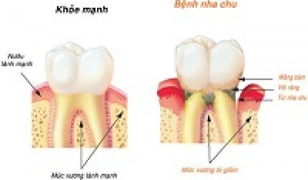 Bệnh lý răng miệng người Việt thường mắc phải
