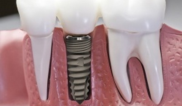 Bí quyết chăm sóc răng đúng cách sau khi cấy ghép răng implant