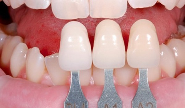 Bọc răng sứ có tốt không và ảnh hưởng đến ăn nhai như thế nào?