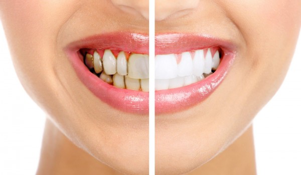 Bọc răng sứ đột phá trong lĩnh vực thẩm mỹ răng