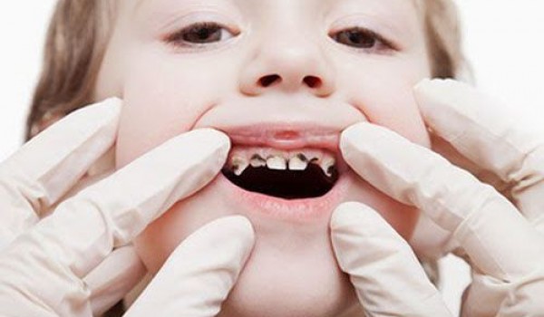 Các bệnh về răng miệng phổ biến hiện nay