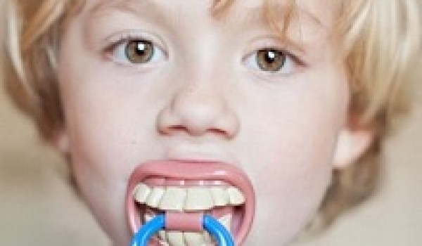 Các thói quen có thể gây lệch lạc răng hàm ở trẻ