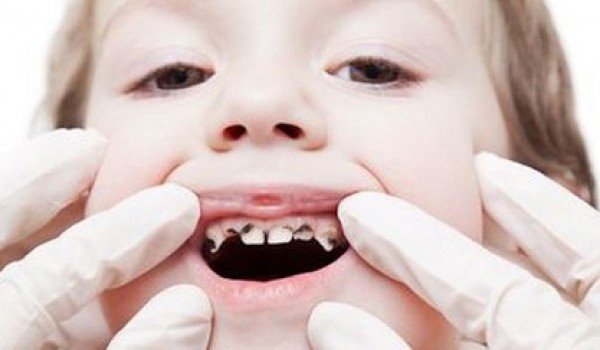 Cẩm nang chăm sóc răng sữa cho trẻ