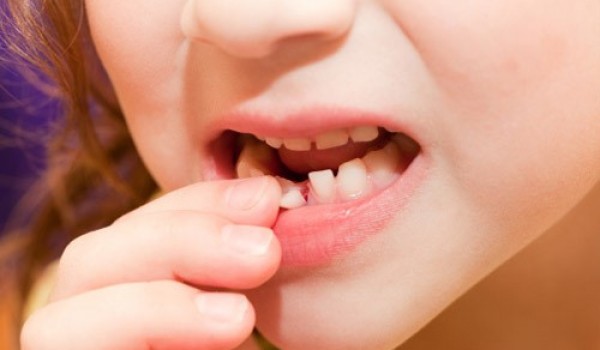 Cần làm gì khi răng bị lung lay