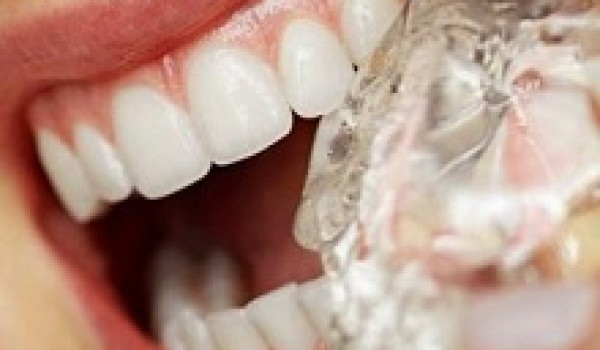 Chăm sóc răng implant sau phục hình như thế nào?