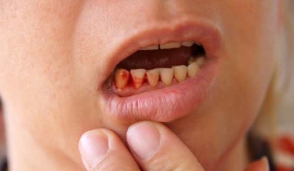 Chảy máu chân răng phải làm sao?