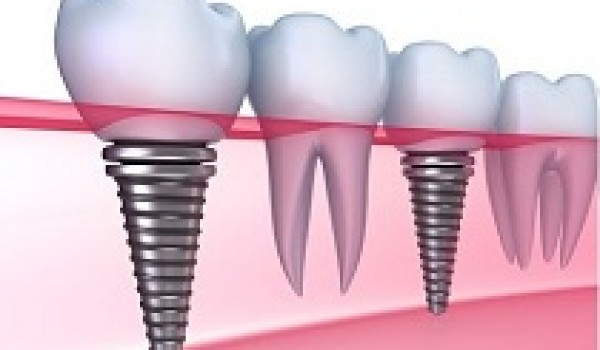 Chi phí cấy ghép Implant tại sao lại cao