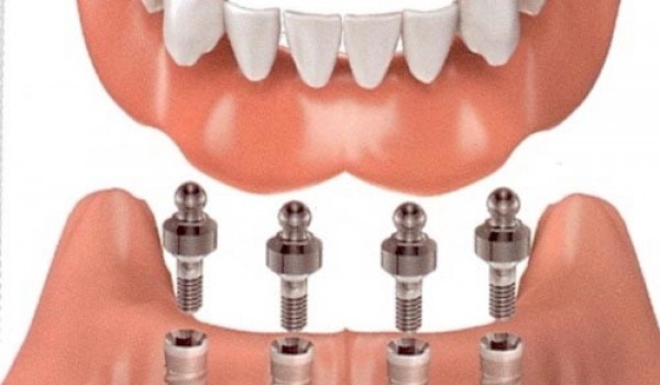 Có nên thực hiện phương pháp trồng răng implant