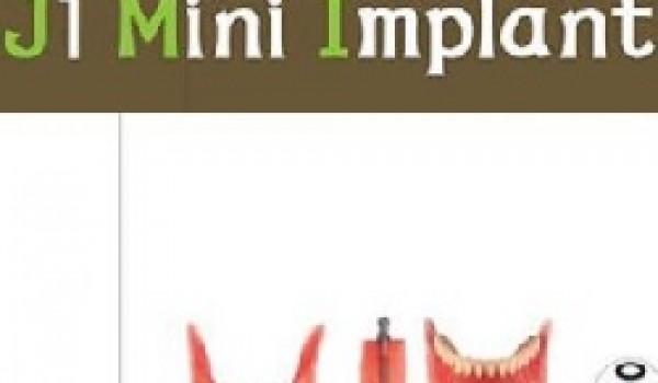 Công nghệ Mini Implant hiện đại có khả năng thay thế implant truyền thống
