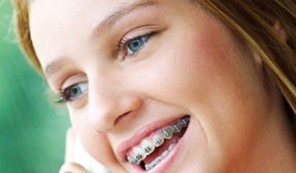 Đặc điểm và cách niềng răng hô hàm trên