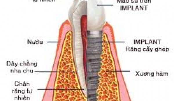 Độ tuổi nào nên và không nên cấy ghép implant?