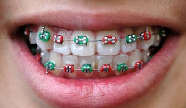 Giái pháp niềng răng hiệu quả tối ưu với mắc cài 3M UGSL