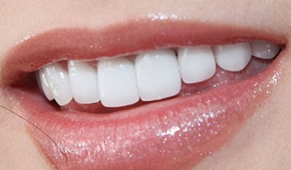 Khi bọc răng sứ cần lưu ý những điều gì?