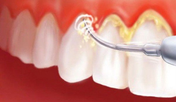 Lấy cao răng bằng máy siêu âm phương pháp thẩm mỹ răng mới