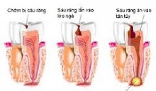 Nhóm thuốc điều trị viêm tuỷ răng