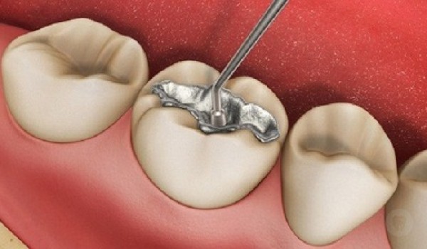 Những điều cần biết về trám răng