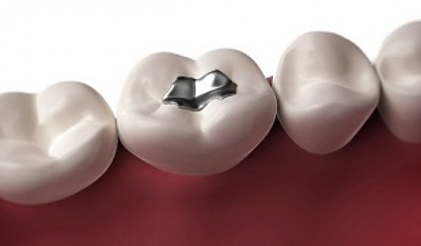 Những lưu ý khi trám răng bằng vật liệu Amalgam