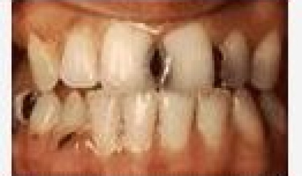 Những nguyên nhân chính dẫn tới sâu răng