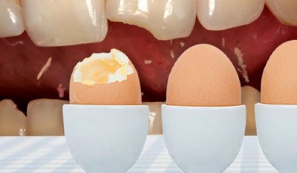 Những tác nhân “vô tình” hại men răng mà bạn không biết