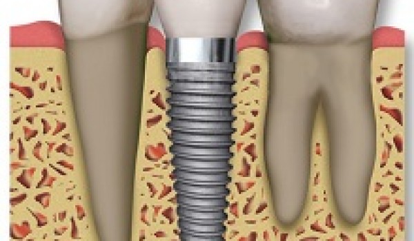 Những trường hợp được cấy ghép implant nha khoa