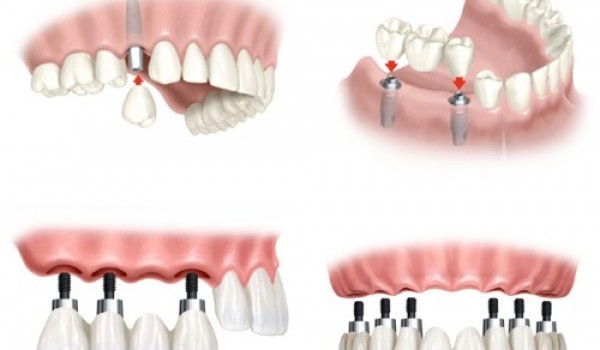 Những ưu điểm của phương pháp cấy ghép Implant