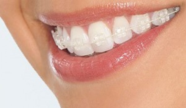 Niềng răng, giải pháp thẩm mỹ răng hiệu quả