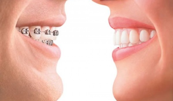 Niềng răng cho người lớn, phương pháp thẩm mỹ răng hô