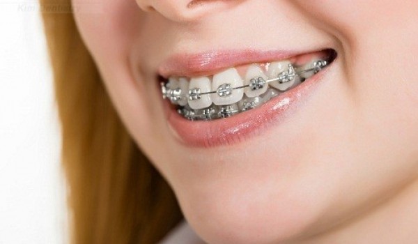Niềng răng có ảnh hưởng gì tới sinh hoạt và sức khỏe hay không?