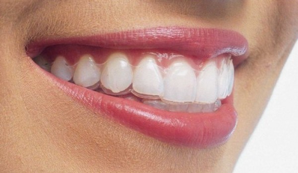 Niềng răng hiệu quả mà không cần nhổ răng