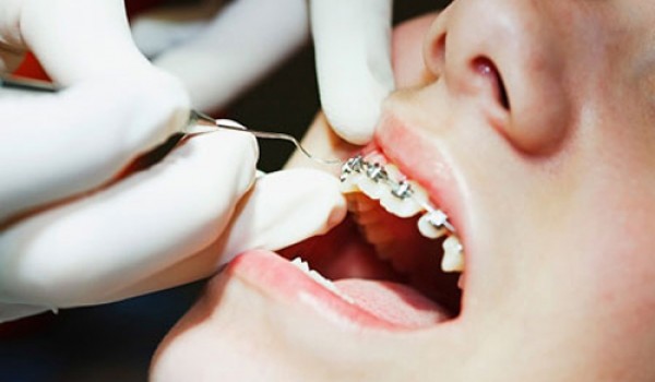 Niềng răng một hàm dưới có được hay không?
