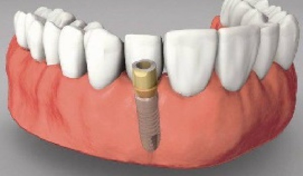 Phân biệt giữa cấy ghép răng implant và trồng răng sứ
