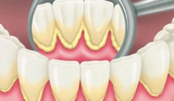 Phân loại vôi răng, quy trình cạo và đánh bóng vôi răng