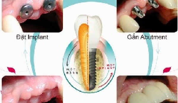 Phục hình cấy ghép Implant mất bao lâu để hoàn thành?