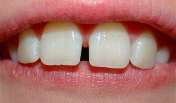 Phương pháp nhanh nhất để giúp răng hết thưa